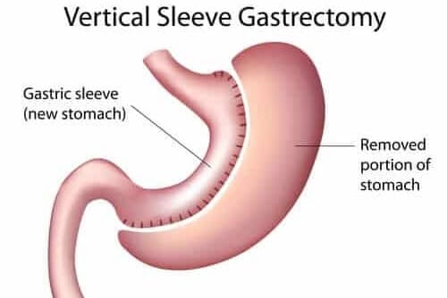 Benefits of Gastric Sleeve Surgery Tijuana Mexico - Jet Medical Tourism