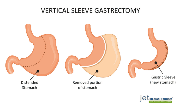 vertical sleeve gastrectomy