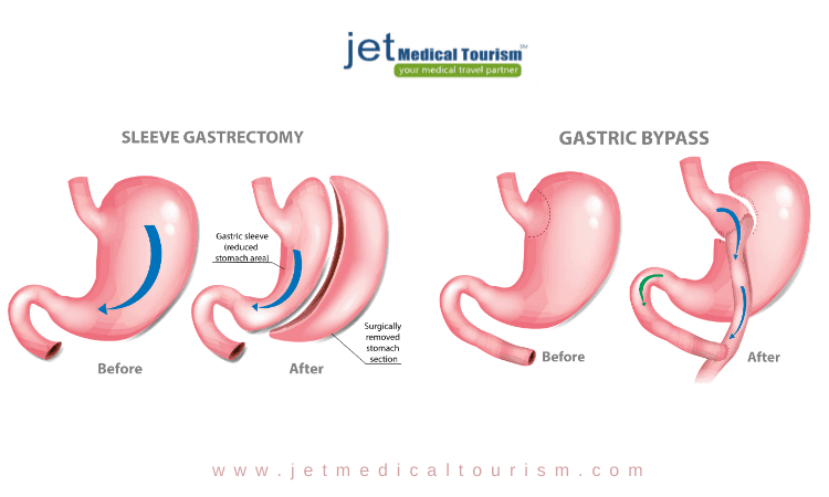 Gastric Bypass and Gastric Sleeve