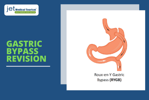 Gastric Bypass Revision