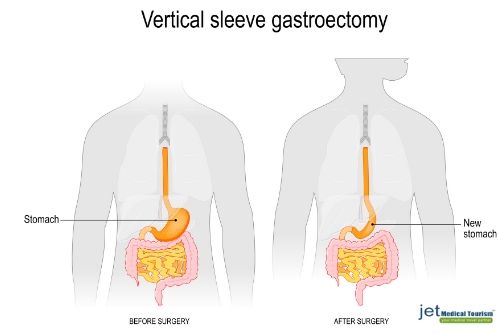 Gastric Sleeve Surgery