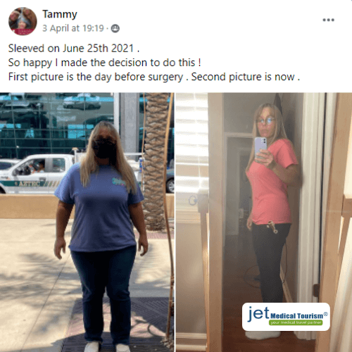 Gastric Sleeve No Regrets