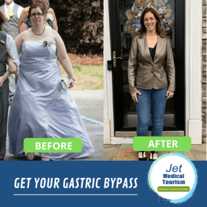 Gastric bypass before and after