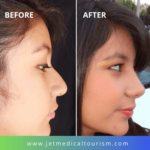 Best Rhinoplasty Surgeons in Mexico