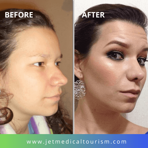 Best Rhinoplasty Surgeons in Mexico