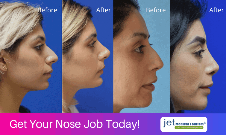 Nose Job Before and After