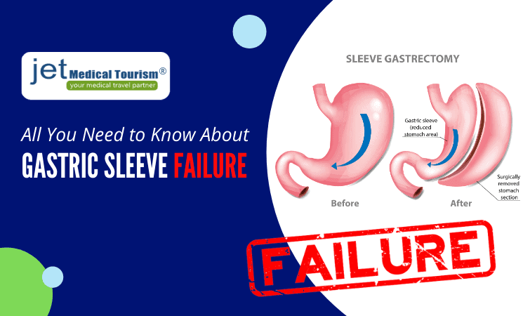 Gastric Sleeve Failure