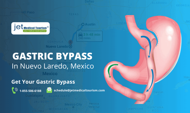 Gastric Bypass Nuevo Laredo, Mexico