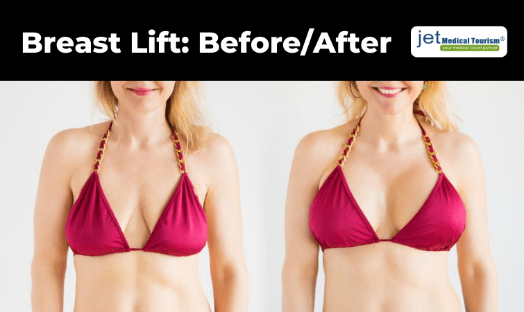 Breast lift before and after