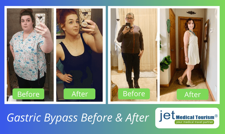 Gastric bypass before and after pictures