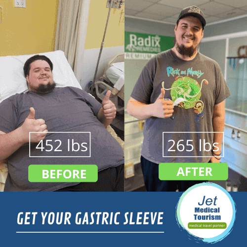 Gastric sleeve before and after male