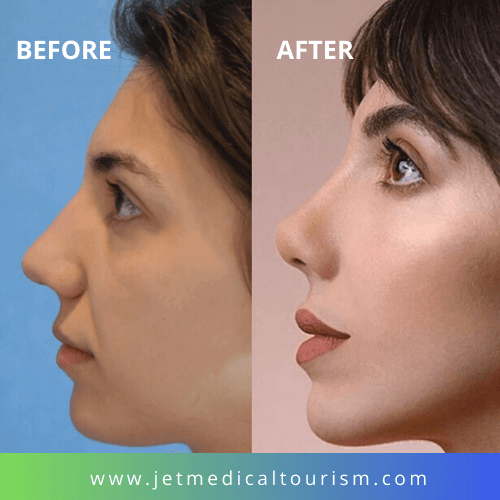 Rhinoplasty, Nose Job in Mexico