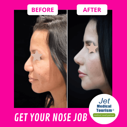 Nose Job Before and After Female