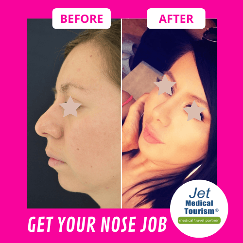 Nose Job Before and After Female