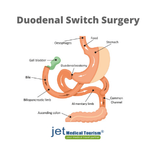 Duodenal Switch Surgery