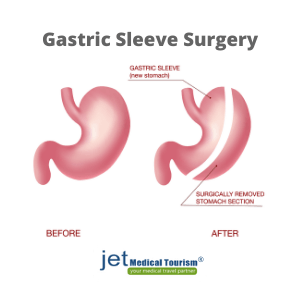 What is gastric sleeve or vsg surgery