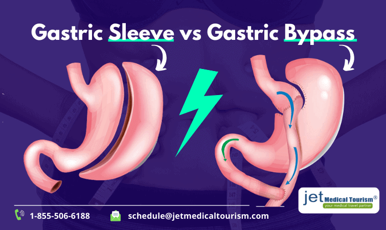 Gastric Sleeve vs Gastric Bypass