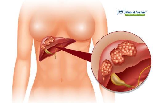 Liver Cancer and Obesity