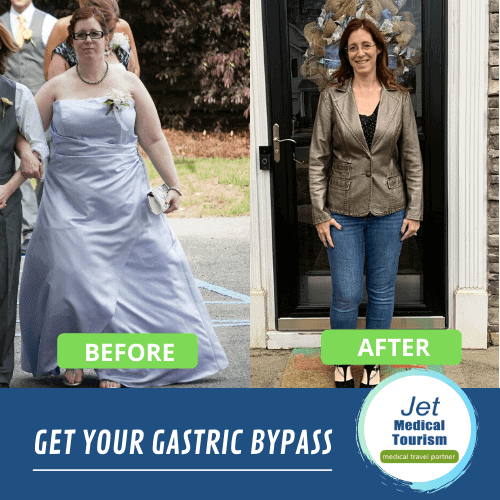 Gastric Bypass Before and After