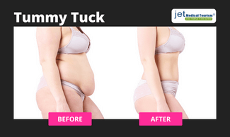 Tummy Tuck Before and After