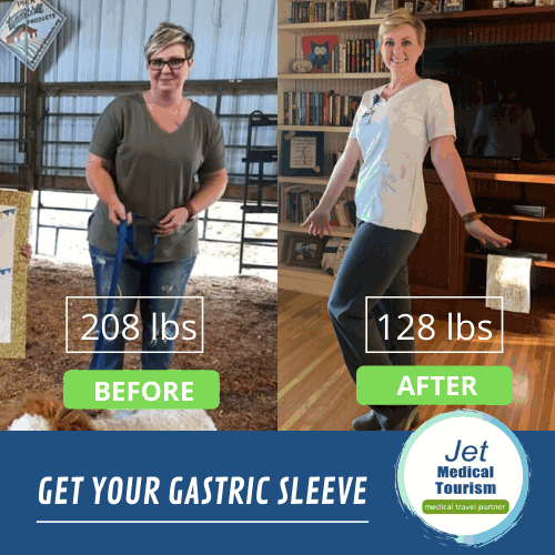 Gastric sleeve before and after