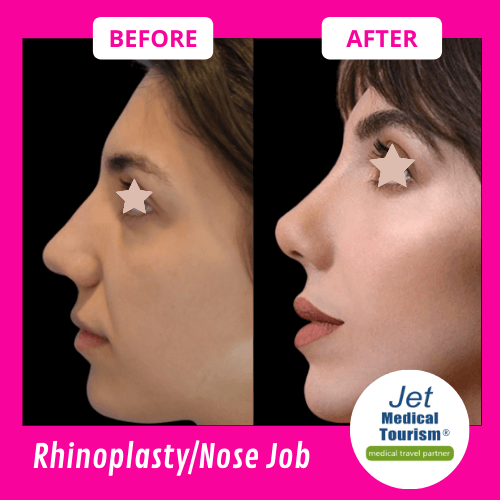 Rhinoplasty Before and After