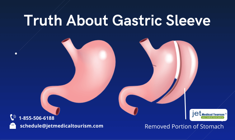 Truth About Gastric Sleeve