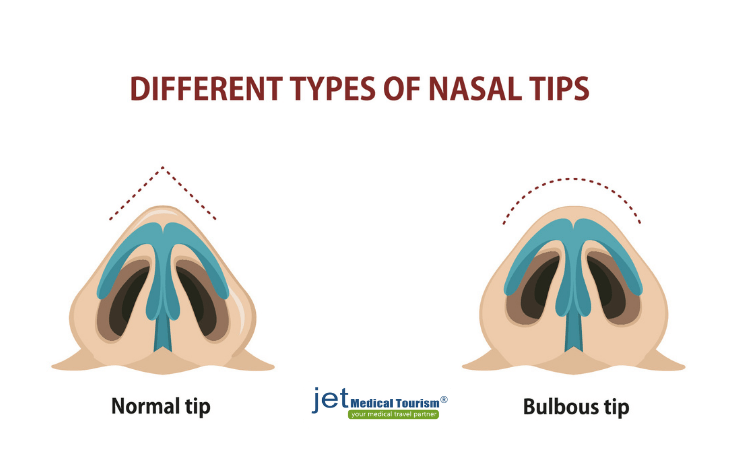 bulbous tip rhinoplasty