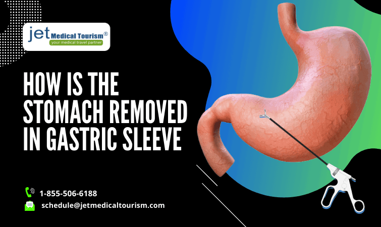 How is the Stomach Removed in Gastric Sleeve