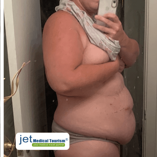 Gastric sleeve scar