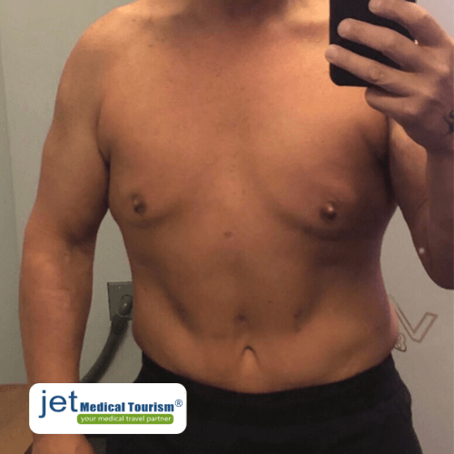 Gastric Sleeve Scars