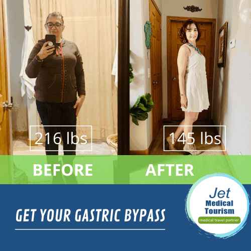 bariatric bypass before and after