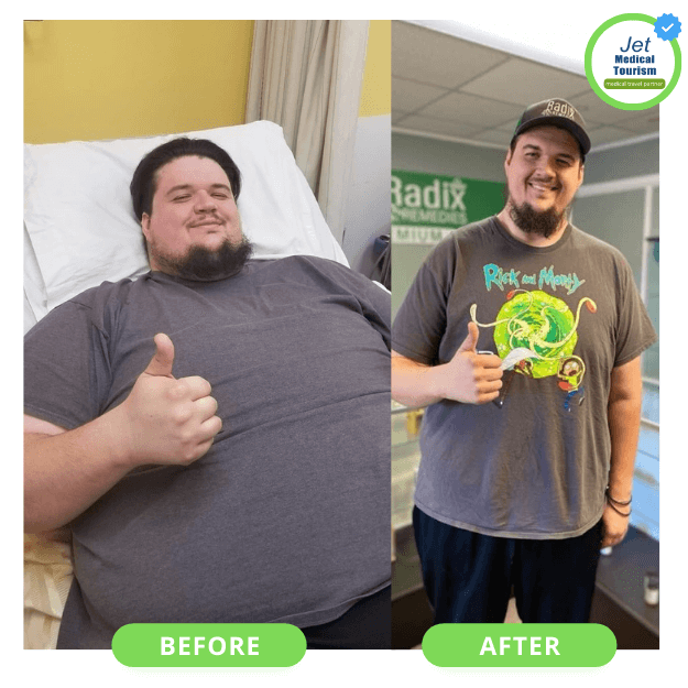 Mexico Gastric Sleeve Surgery Before and After Male Picture