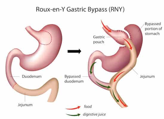 gastric bypass surgery