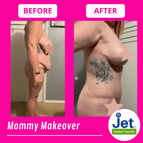 Mommy Makeover Before and After