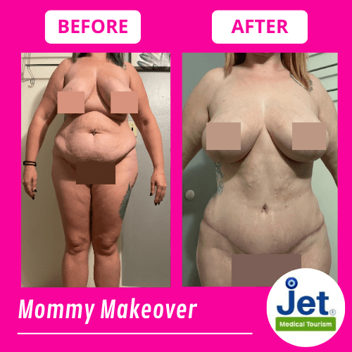 Mommy Makeover Before and After