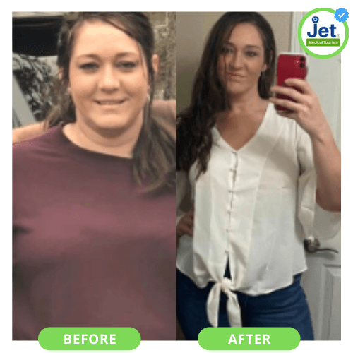 Candy's Gastric sleeve before and after photo