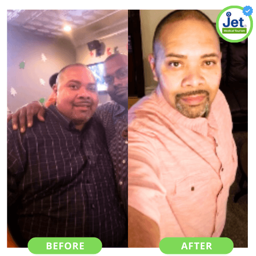 Gastric sleeve surgery before and after male