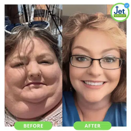 Gastric sleeve in mexico