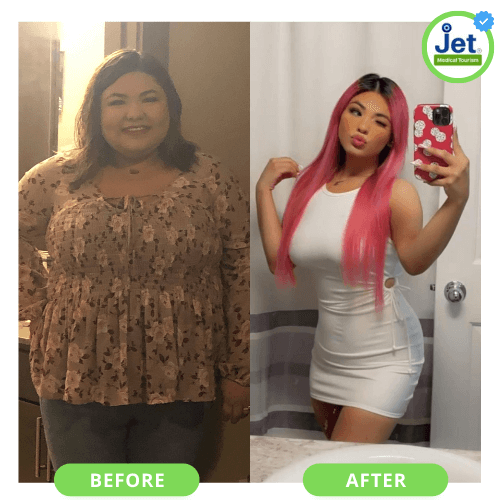 Gastric sleeve surgery before and after