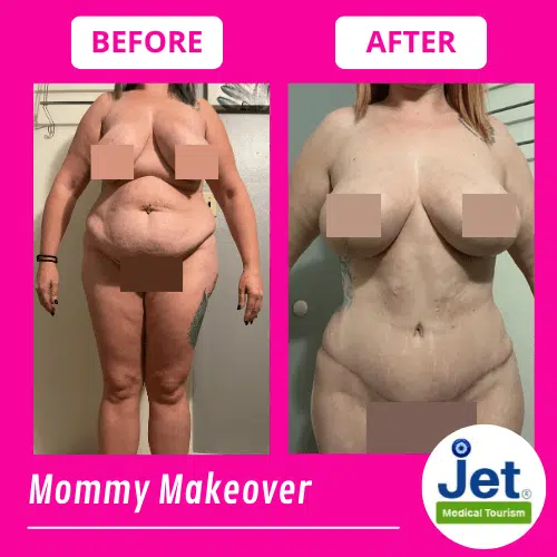 Mommy Makeover Before and After