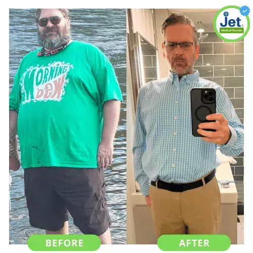 Before and after transformation of a patient following gastric sleeve surgery, highlighting significant weight loss and enhanced well-being.