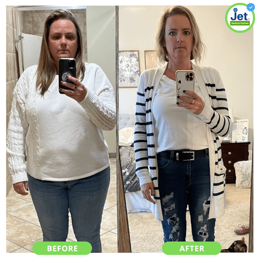 Tijuana Gastric Sleeve Testimonial