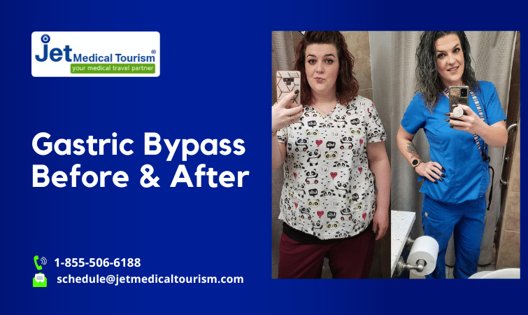 Gastric Bypass Before and After Photos