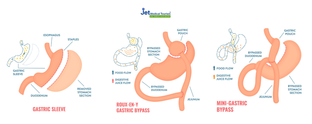 Bariatric Surgery Procedures