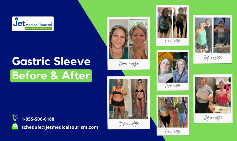 Gastric sleeve before and after pictures